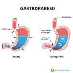 Gastroparesis, A Lesser Known Diabetes Complication