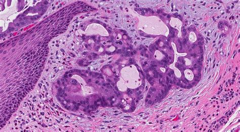 invasive adenocarcinoma Archives | Atlas of Pathology