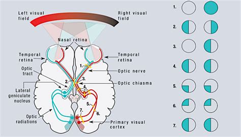 Visual Fields, Field Loss and Functional Vision Testing | WonderBaby.org