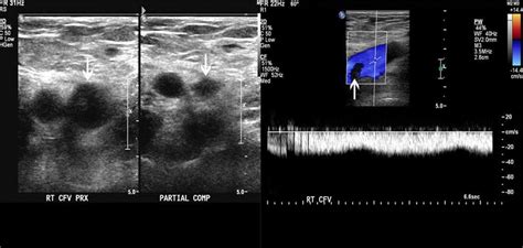 Deep Venous Thrombosis (DVT) - Cardiovascular Disorders - MSD Manual Professional Edition