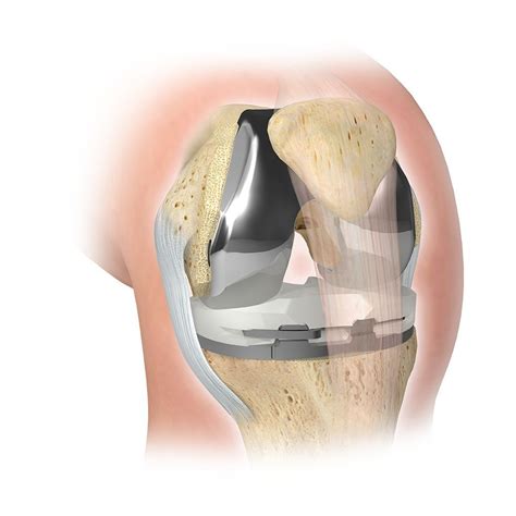 Zimmer Biomet - Knee Replacement | Knee replacement, Artificial knee, Knee replacement surgery