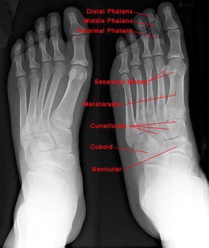 Foot X-ray - Normal Findings | Bone and Spine