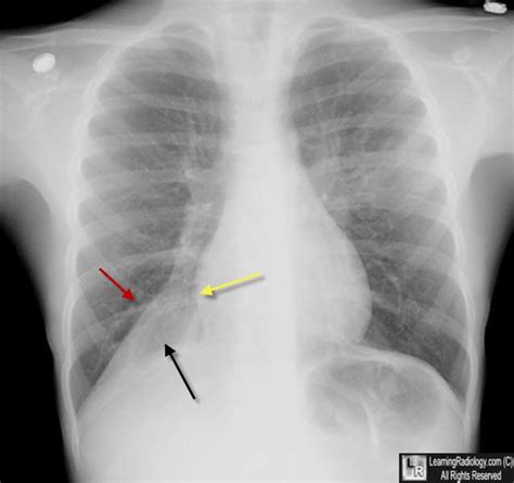 rll, right lower lobe, atelectasis | Radiology, Resume, Sample resume