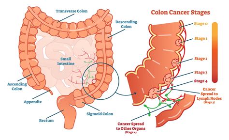 Colon & Rectal Cancer (Colorectal Cancer) Treatment - Alaska Surgical ...