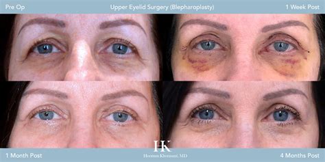 9 Tips to Speed Recovery After Eyelid Surgery (Blepharoplasty)