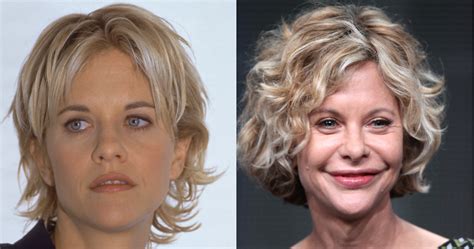 Meg Ryan | Plastic Surgery Disasters | Purple Clover