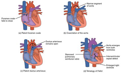 congenital heart defects - Google Search | PA School Stuff | Pinterest | Heart, Search and ...