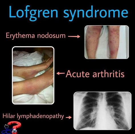 Lofgren Syndrome - MEDizzy