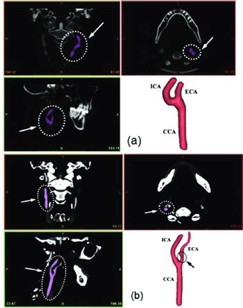 Different views of CT scan of carotid bifurcation, case-(a) Normal ...