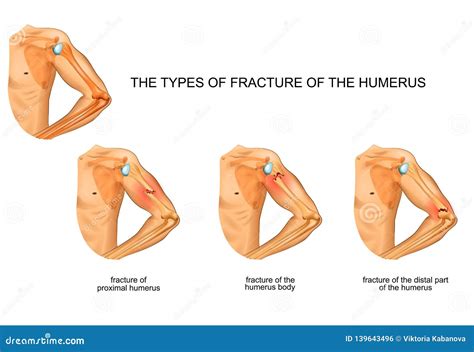 Humerus Fracture, Trauma, Surgery Stock Vector - Illustration of ...