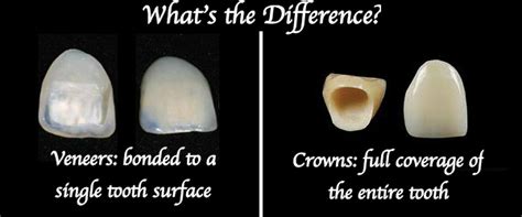 Dental Questions: What is the difference between a Crown and a Veneer?