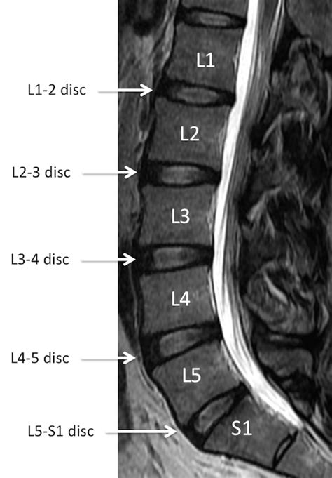 Mri Lumbar Spine Anatomy - Anatomy Reading Source