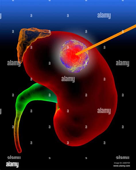 Cancer du rein L'ablation thermique. Illustration de l'ablation ou ...