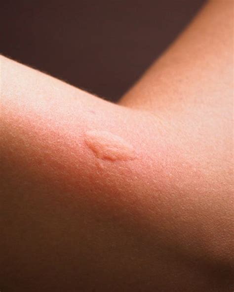 11 Common Bug Bite Pictures - How to ID Insect Bites and Stings