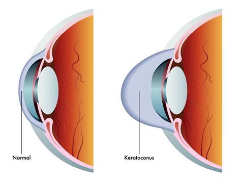 Keratoconus: Symptoms & Treatment Options | Atlantic Eye Institute