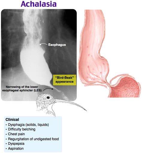 Achalasia | Medical school studying, Medical knowledge, Medical mnemonics