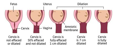 Cervical Dilation