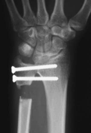 The Distal Radioulnar Joint: Acute Injuries and Chronic Injuries ...