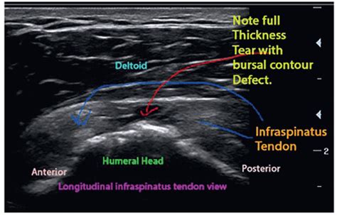 Ultrasound-Guided Injection Technique for Infraspinatus Tendonitis ...