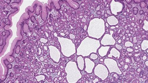 Fundic gland polyp of the stomach | Atlas of Pathology