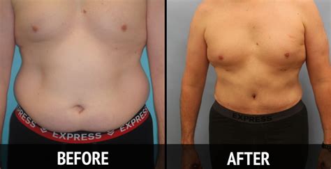 Tummy Tuck Before and After