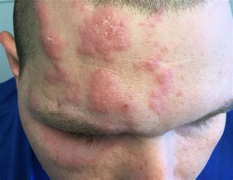 DermDx: Headache, Malaise, and a Rash - Dermatology Advisor