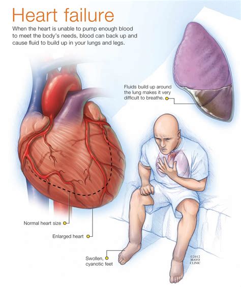 Signs Of Heart Failure : NCLEX Question: CHF Manifestations of Right sided heart ... : Not all ...