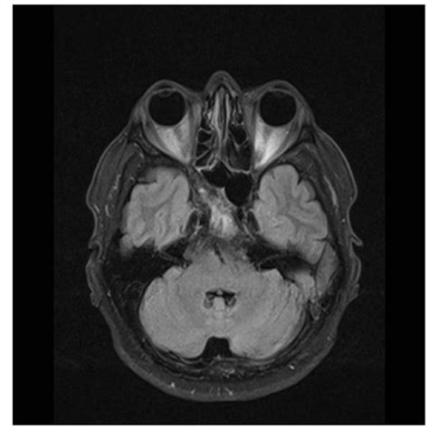 Brain MRI showing a tumor in the clivus and involvement of sphenoid bone | Download Scientific ...