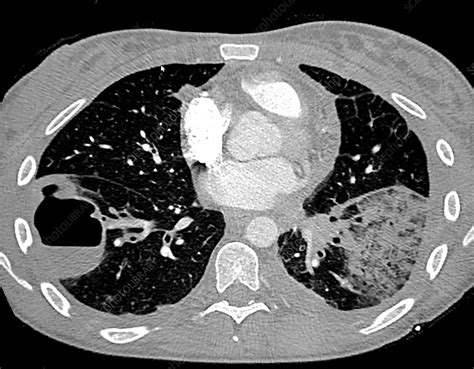 Pneumonia and Lung Abscess, CT - Stock Image - C039/4180 - Science Photo Library