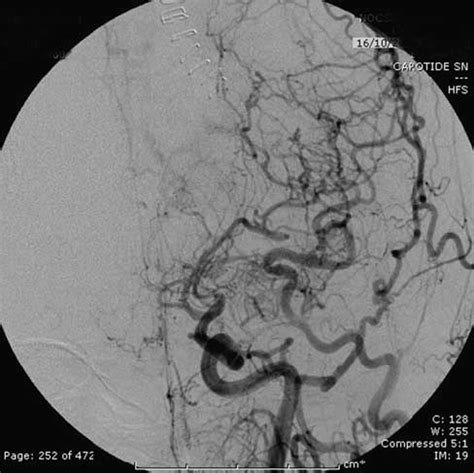 Angiography confirmed the diagnosis of Moyamoya disease | Download Scientific Diagram