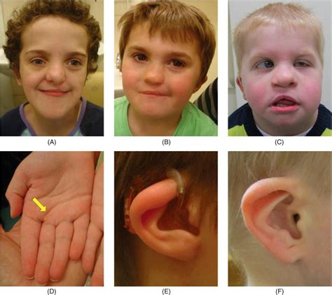 8: Genetic Syndromes and Associations in Congenital Heart Disease | Anesthesia Key