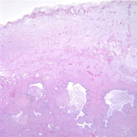 Pathology Outlines - Adenomyosis of gallbladder