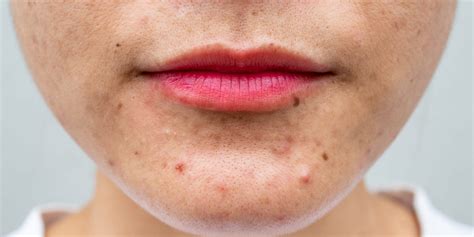 Dry Skin and Acne: Causes and Treatments