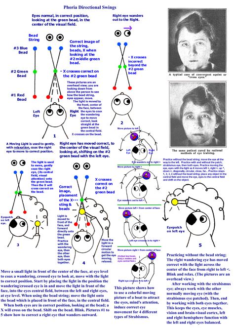 STRABISMUS - Crossed/wandering eyes