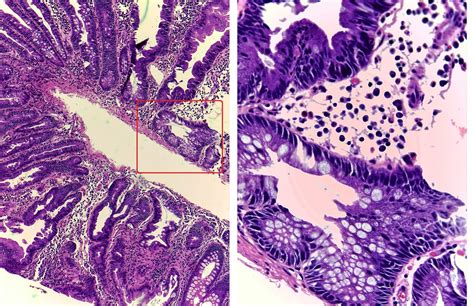 GASTROINTESTINAL AND LIVER HISTOLOGY PATHOLOGY ATLAS: SESSILE SERRATED POLYP (AKA SESSILE ...