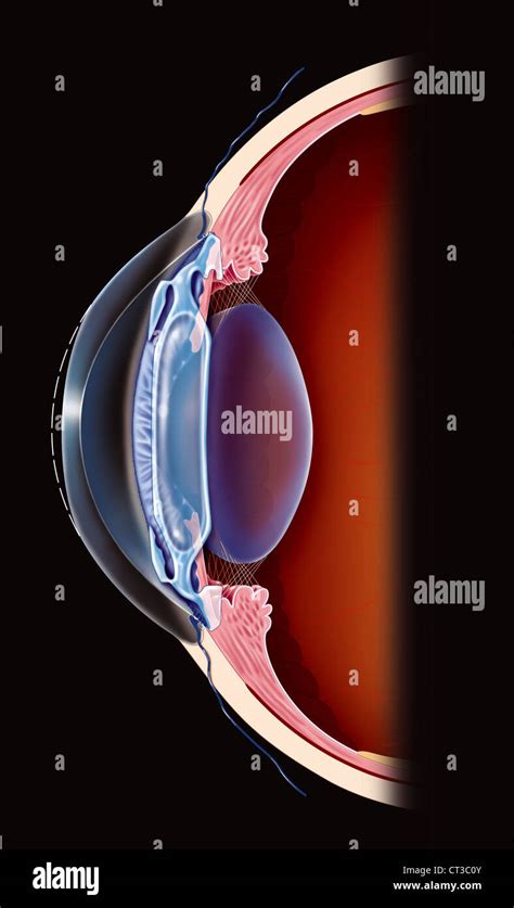 PRESBYOPIA SURGERY, ILLUSTRATION Stock Photo - Alamy