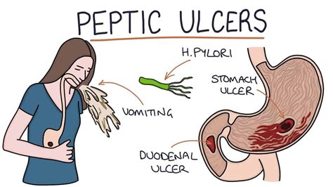 Ulcer la stomac - amed.md