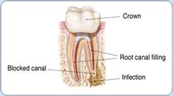 New York Root Canal Retreatment, Root Canal Specialist Manhattan, NYC