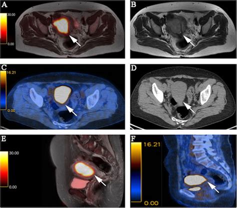 For staging endometrial cancer: PET/MRI or PET/CT?