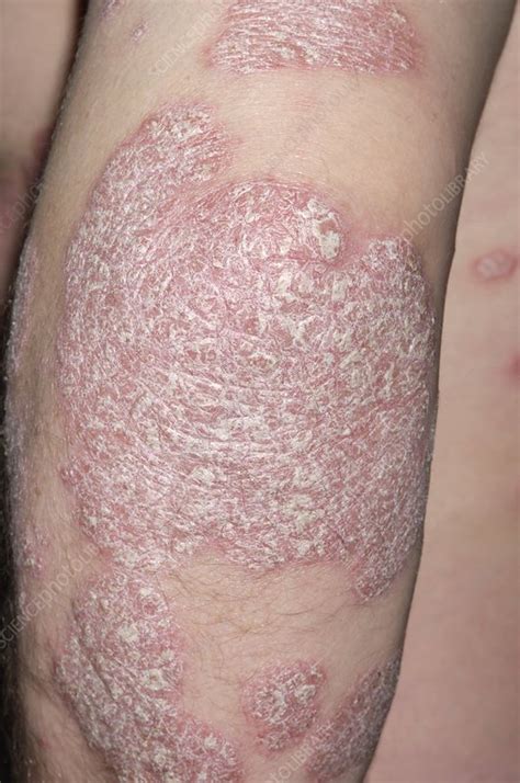 Chronic plaque psoriasis on arm - Stock Image - M240/0767 - Science Photo Library