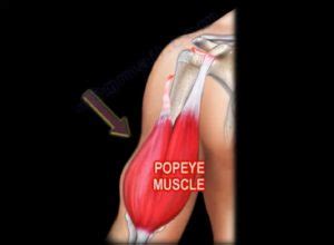 Proximal Biceps Tendon Rupture — OrthopaedicPrinciples.com