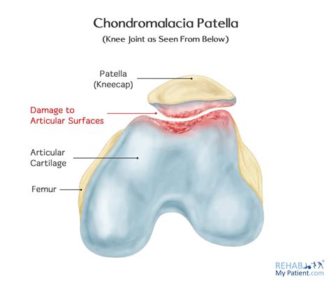 Knee Chondromalacia Patella Exercises