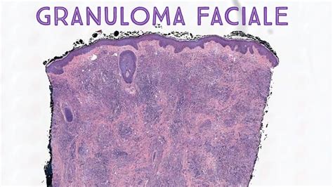 Granuloma faciale (with erythema elevatum diutinum-like fibrosis) pathology histology ...