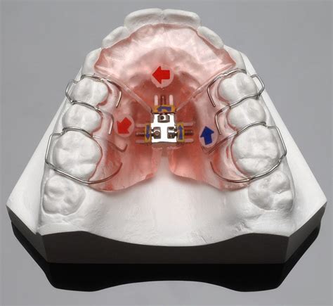 3-Way Palatal Expander/Orthodontic Expansion Appliance - China 3-Way Palatal Expander and ...