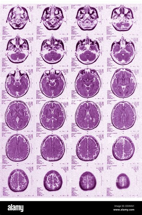 Normal mri sinuses hi-res stock photography and images - Alamy