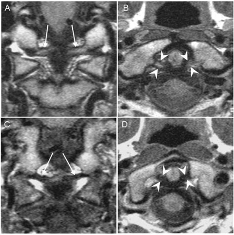 MRI of alar and transverse ligaments. High-resolution proton-weighted... | Download Scientific ...