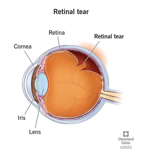 Retinal Tear: Symptoms, Causes & Treatment