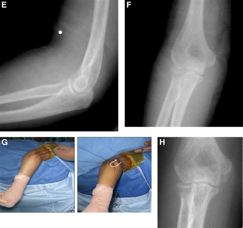 Arthroscopic-Assisted Treatment of Coronoid Fractures - Arthroscopy