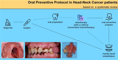 Dentistry Journal | Free Full-Text | Management of Oral Hygiene in Head ...