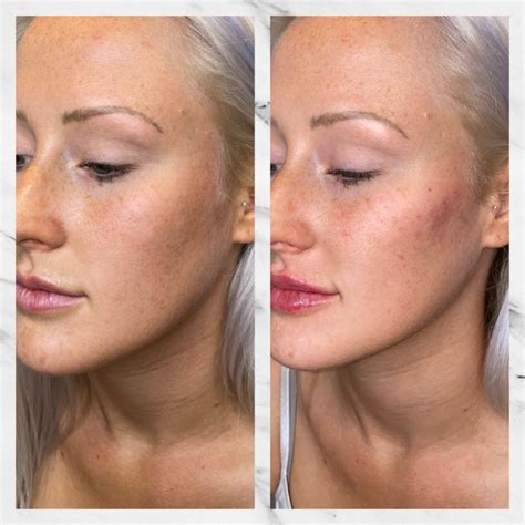 Face Fillers & Cheek Fillers in Gilbert | Colair Med Spa